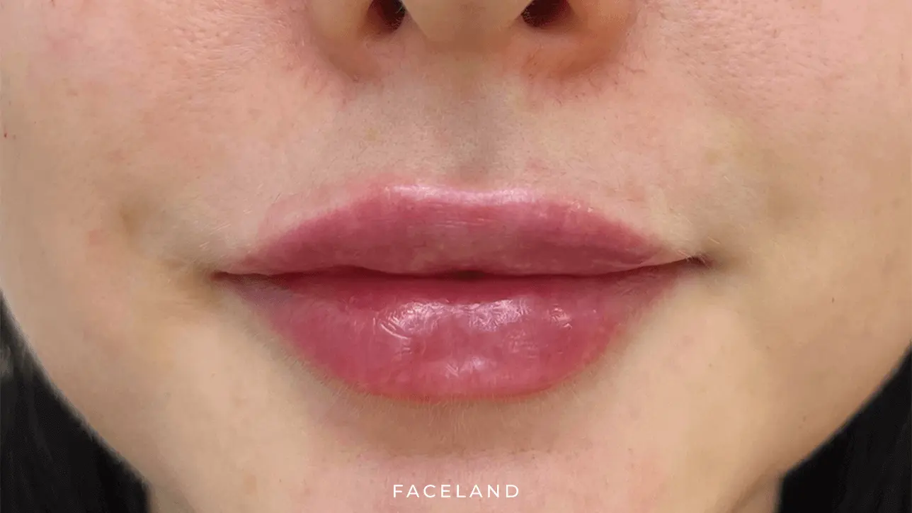 Lippen aufspritzen