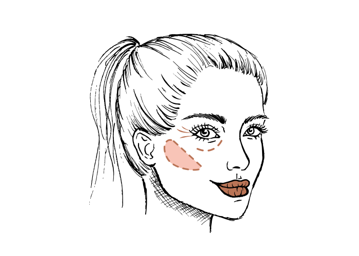 Waarom fillers beter zijn dan een PDO draadlift