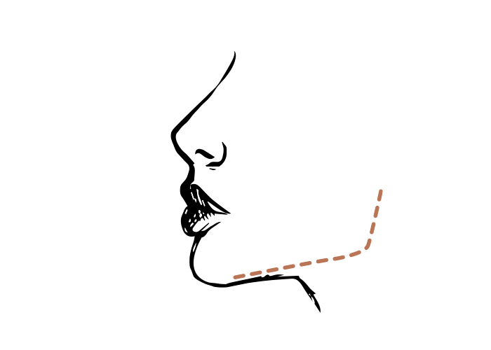 Jawline 1 ml Hyaluron Belotero
