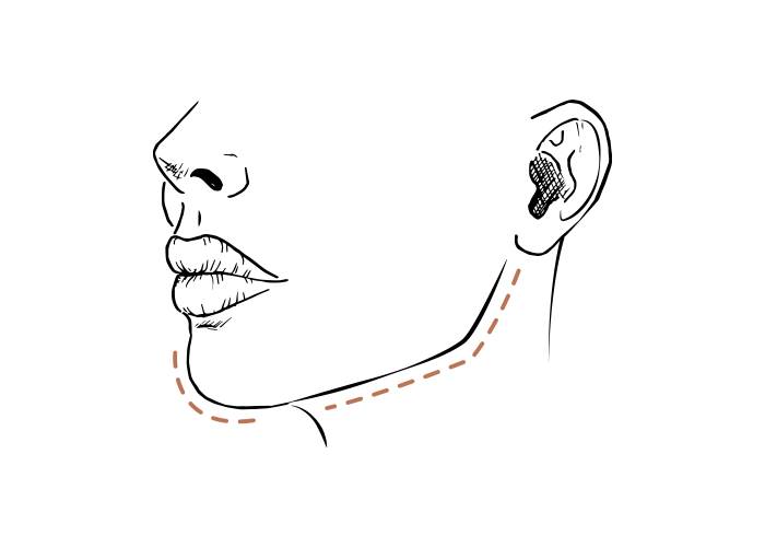 Van geen kaaklijn naar strakke kaaklijn: dit doen fillers