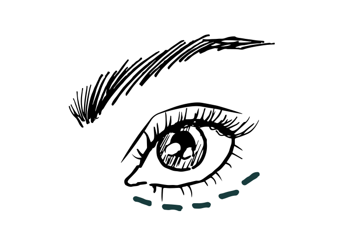 Augenringe 1 ml Belotero