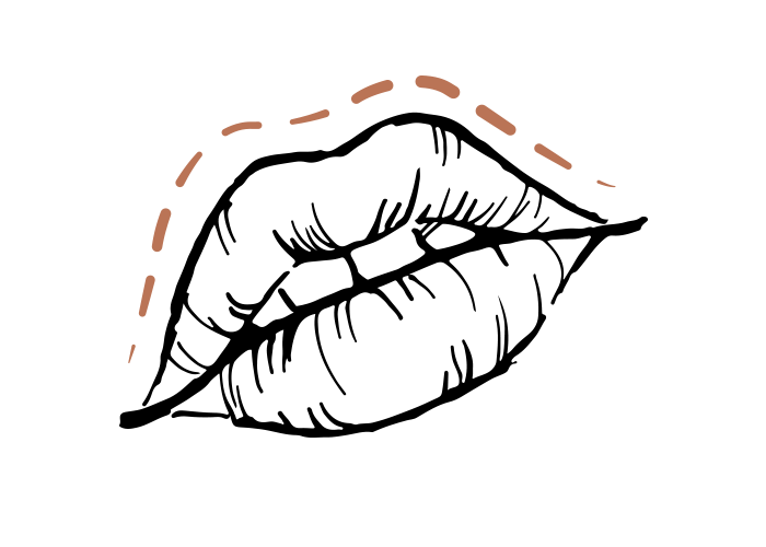 Raucherfältchen 1 ml Hyaluron Juvéderm