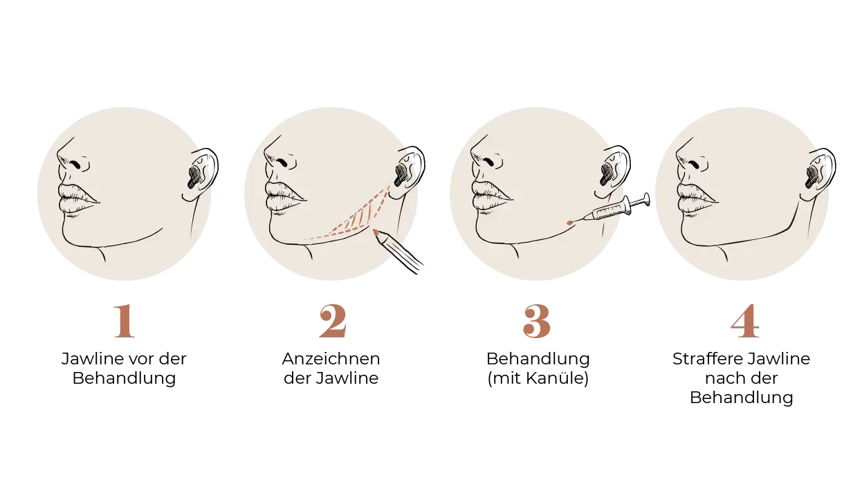 Ablauf Jawline Filler Behandlung