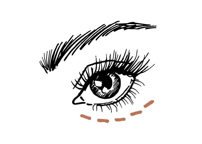 Augenringe unterspritzen