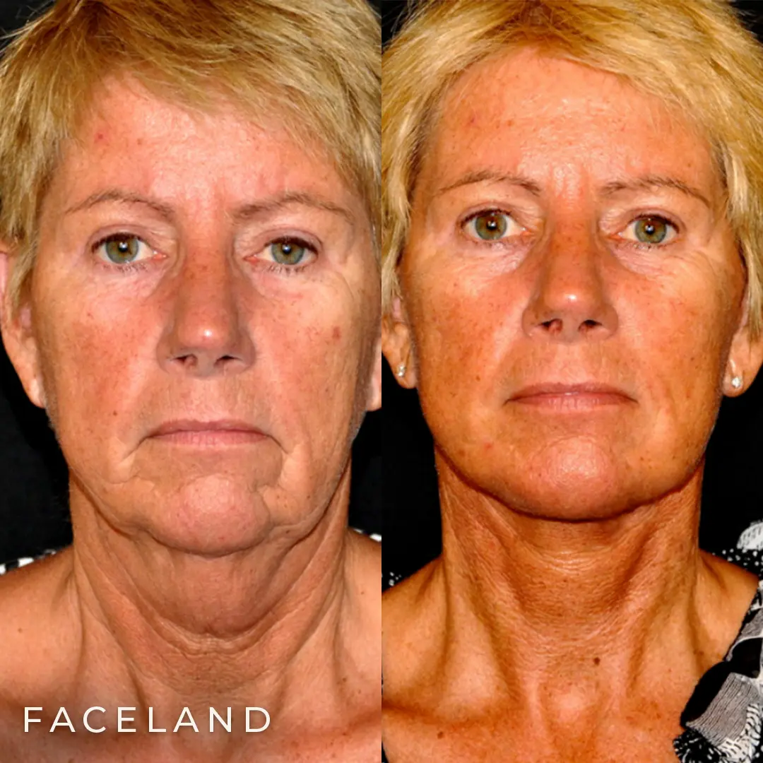 Facelift resultaat