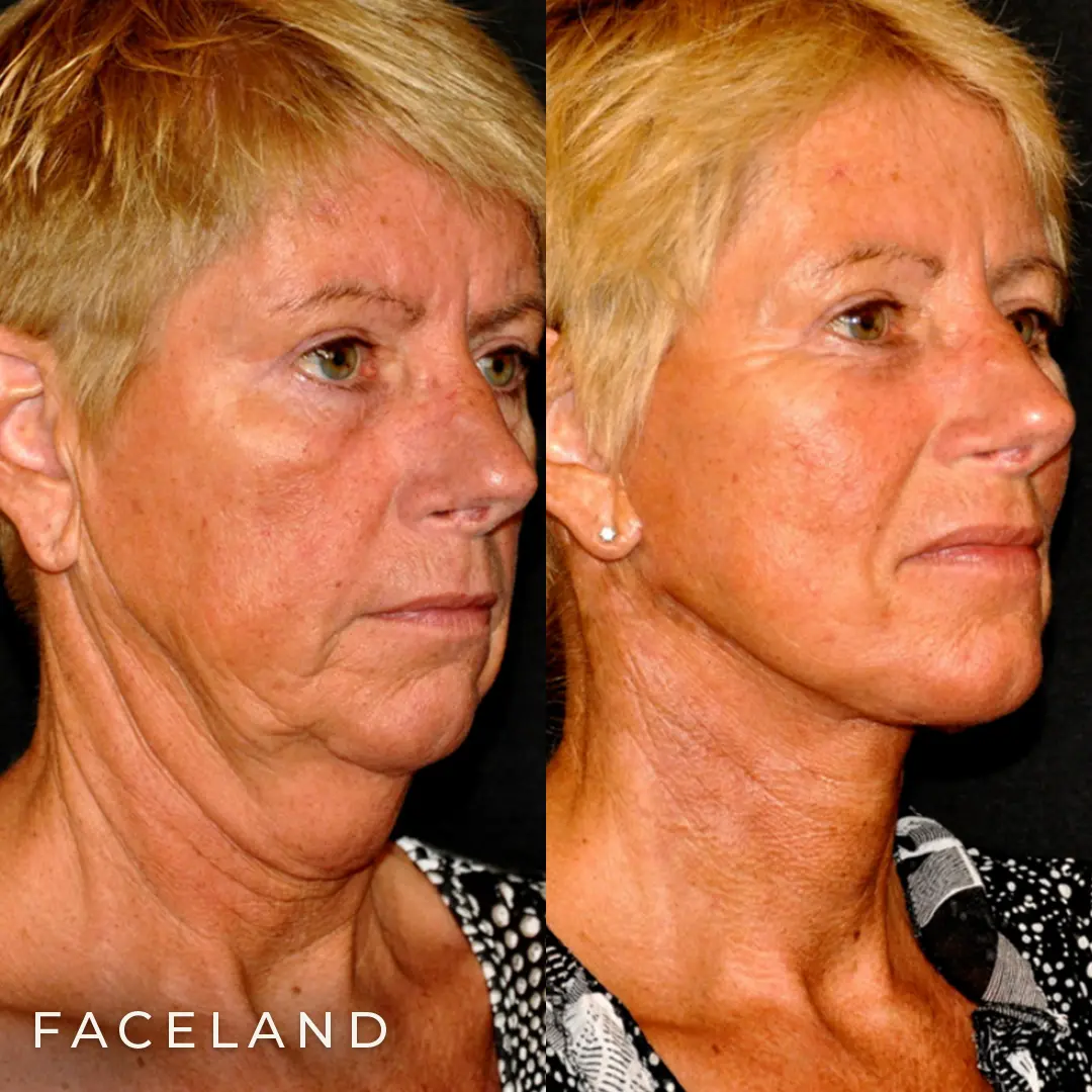 Facelift al voor €5.940, Face your beauty