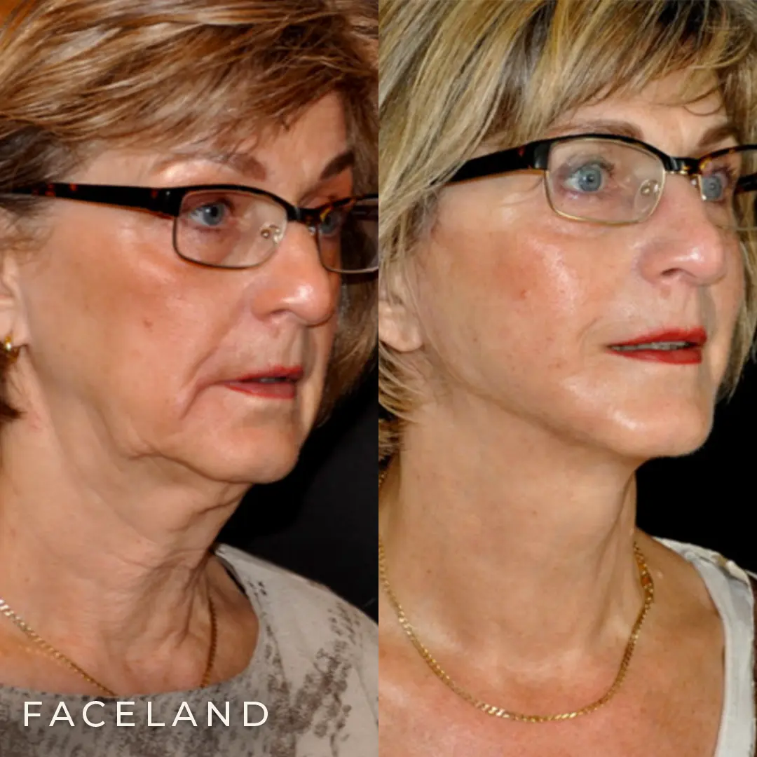 Facelift behandeling