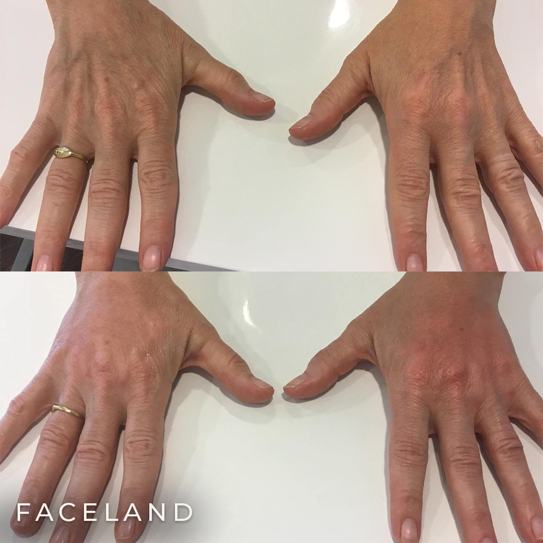 Wat zijn handen fillers?