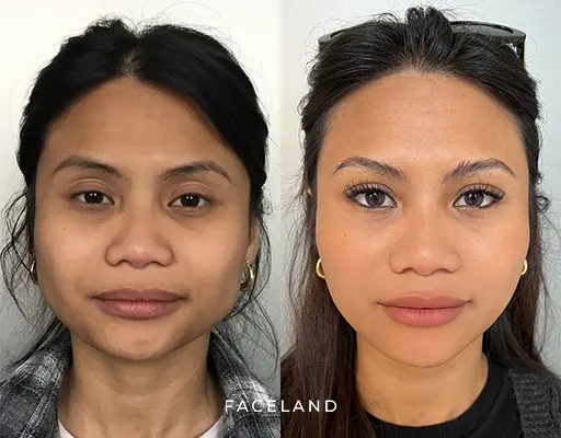 Face slimming before en after