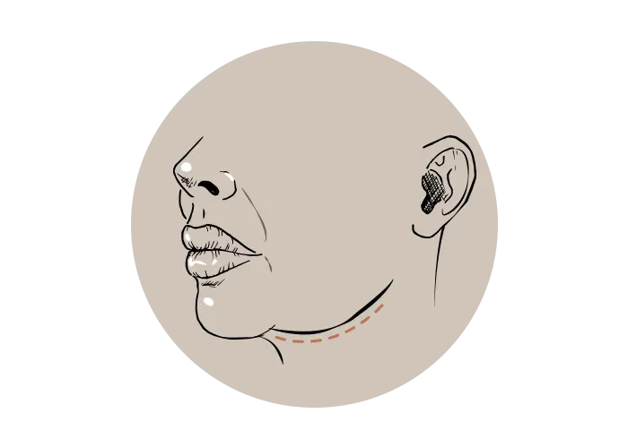 Onderkin trainen of fillers: wat werkt écht?
