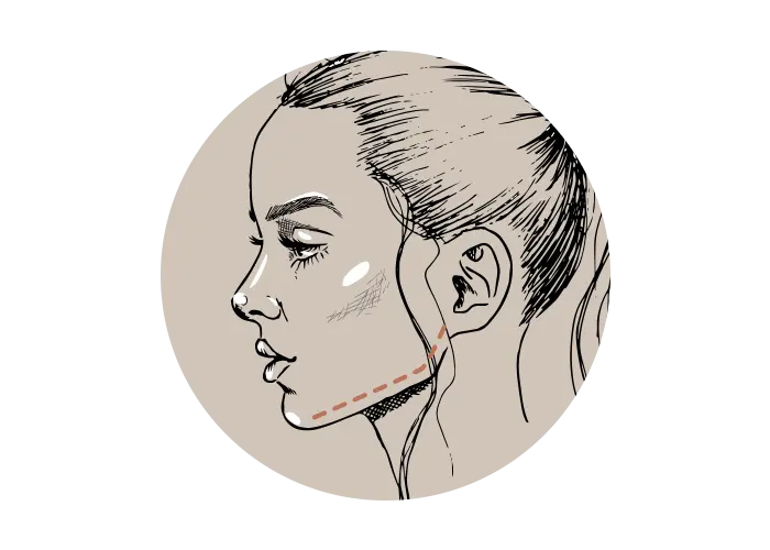 Kauwgom kauwen voor strakke kaaklijn? Nee, ga voor fillers!