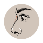 Nasenkorrektur ohne OP