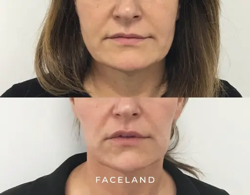 Face slimming resultaat