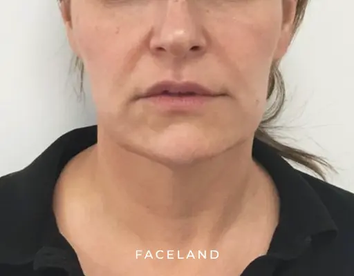 Face slimming resultaat