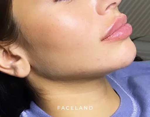 Kaaklijn fillers voor €250,- | Face your beauty |Faceland Kaaklijn Fillers Voor €250,- | Face Your Beauty |Faceland