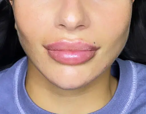 Lip filler behandeling