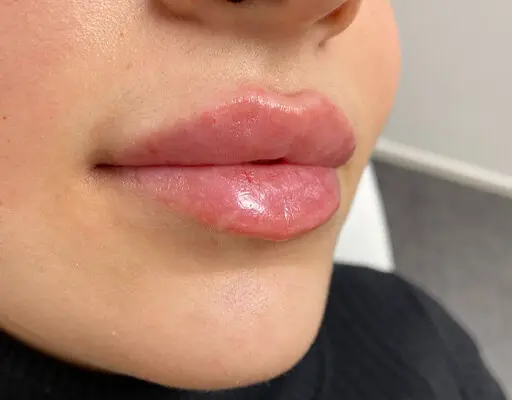 Lip fillers before and after