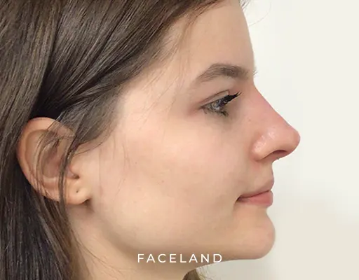 Neus Fillers Vanaf €355| Face Your Beauty | Faceland