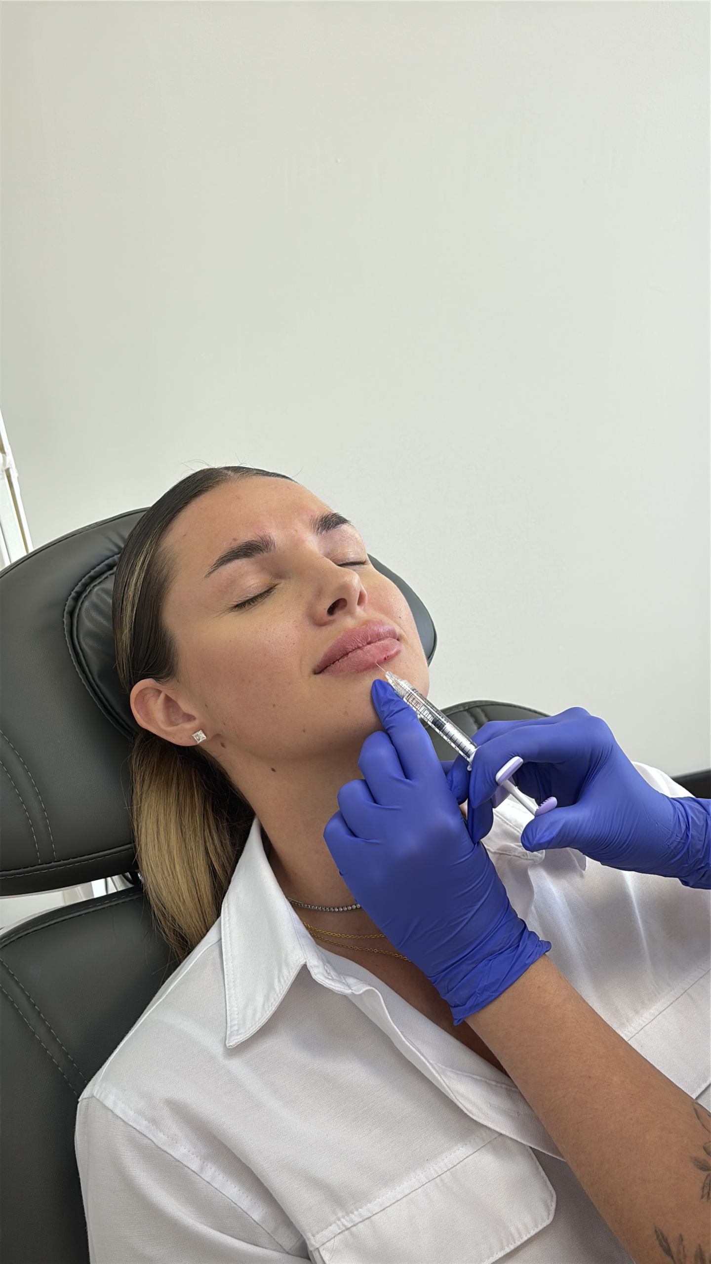 Stappenplan lip filler behandeling