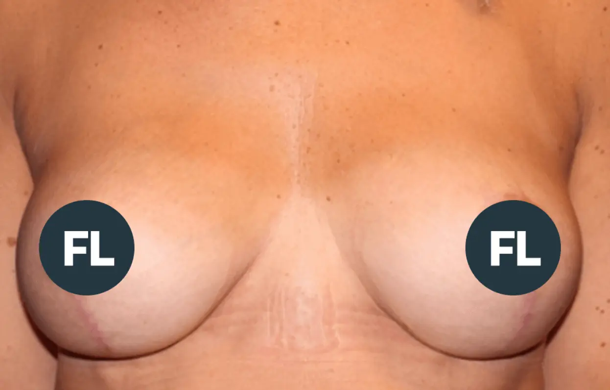 Breast Lift