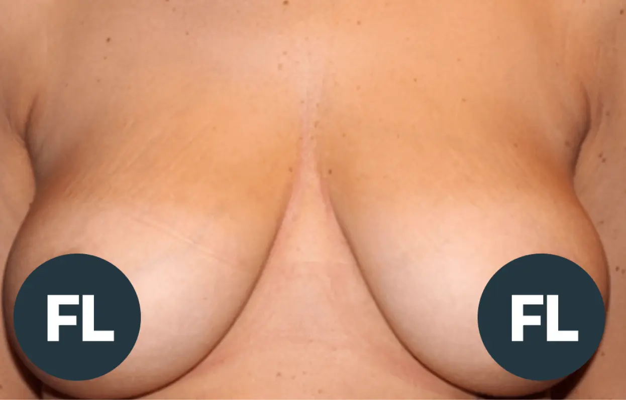 Breast Lift