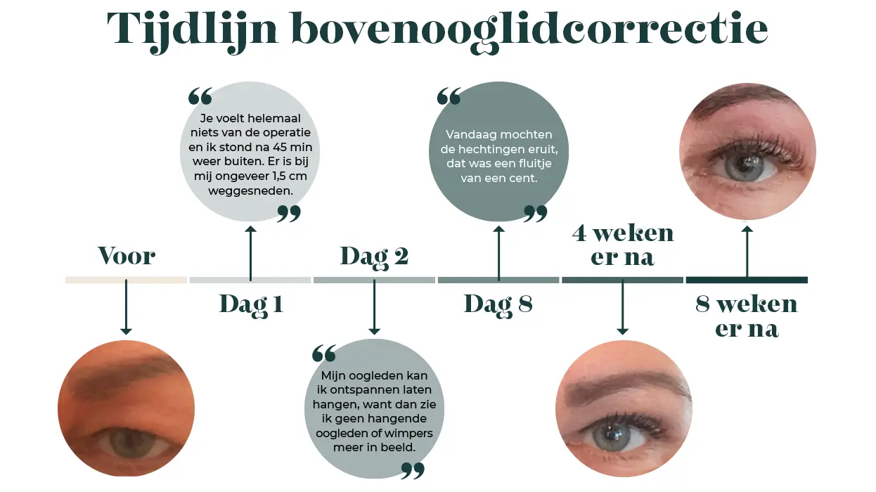 Ooglidcorrectie herstel per dag