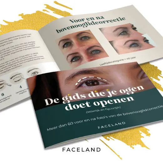 Bovenooglidcorrectie
