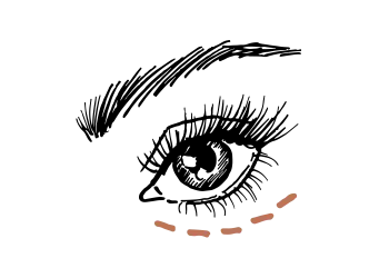Traangoot filler