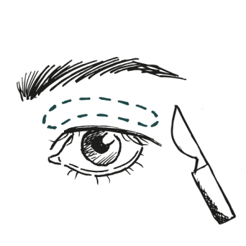 Gemma vloog naar Nederland voor een bovenooglidcorrectie bij Faceland