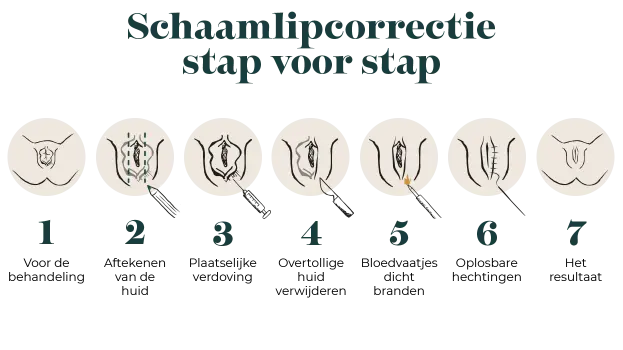 Schaamlipcorrectie stap voor stap