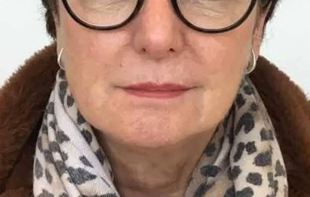 Marionetlijnen filler