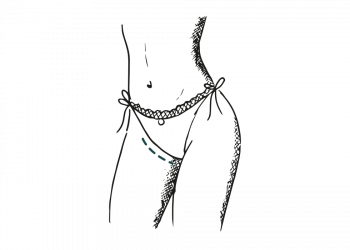 Correction labiaplastie