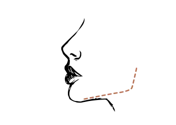 Kaaklijn fillers