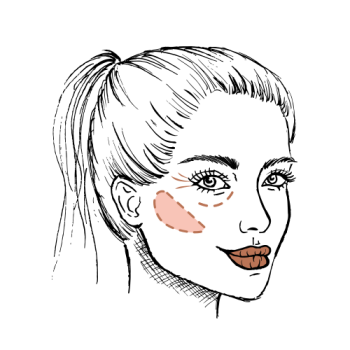 Waarom fillers beter zijn dan een PDO draadlift