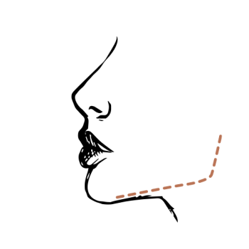 Kaaklijn trainen of fillers? Dit werkt het best
