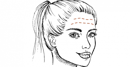 Voorhoofdrimpels