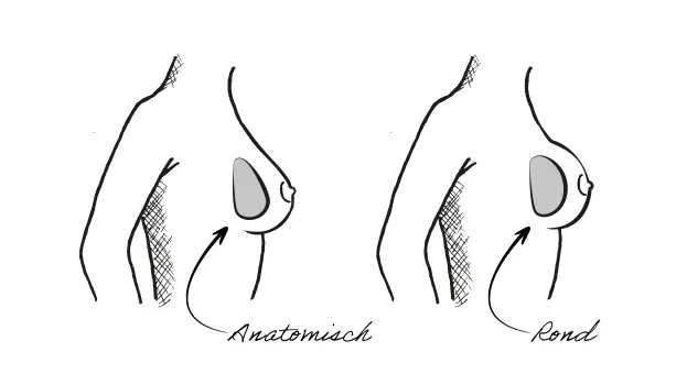 Een anatomische prothese voor natuurlijk resultaat