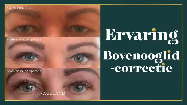 Klantervaring bovenooglidcorrectie herstel