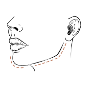 Van geen kaaklijn naar strakke kaaklijn: dit doen fillers