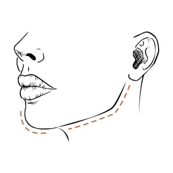 Van geen kaaklijn naar strakke kaaklijn: dit doen fillers