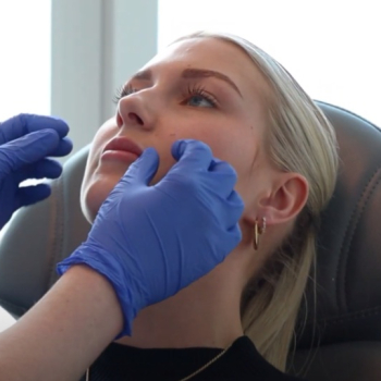 Een natuurlijk vollere glimlach: Milou’s lip filler ervaring