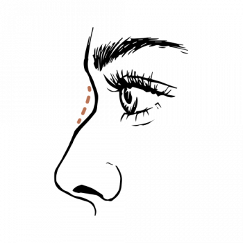 Wil je een neuscorrectie zonder operatie? Dat kan met de 2-point Rhino techniek!