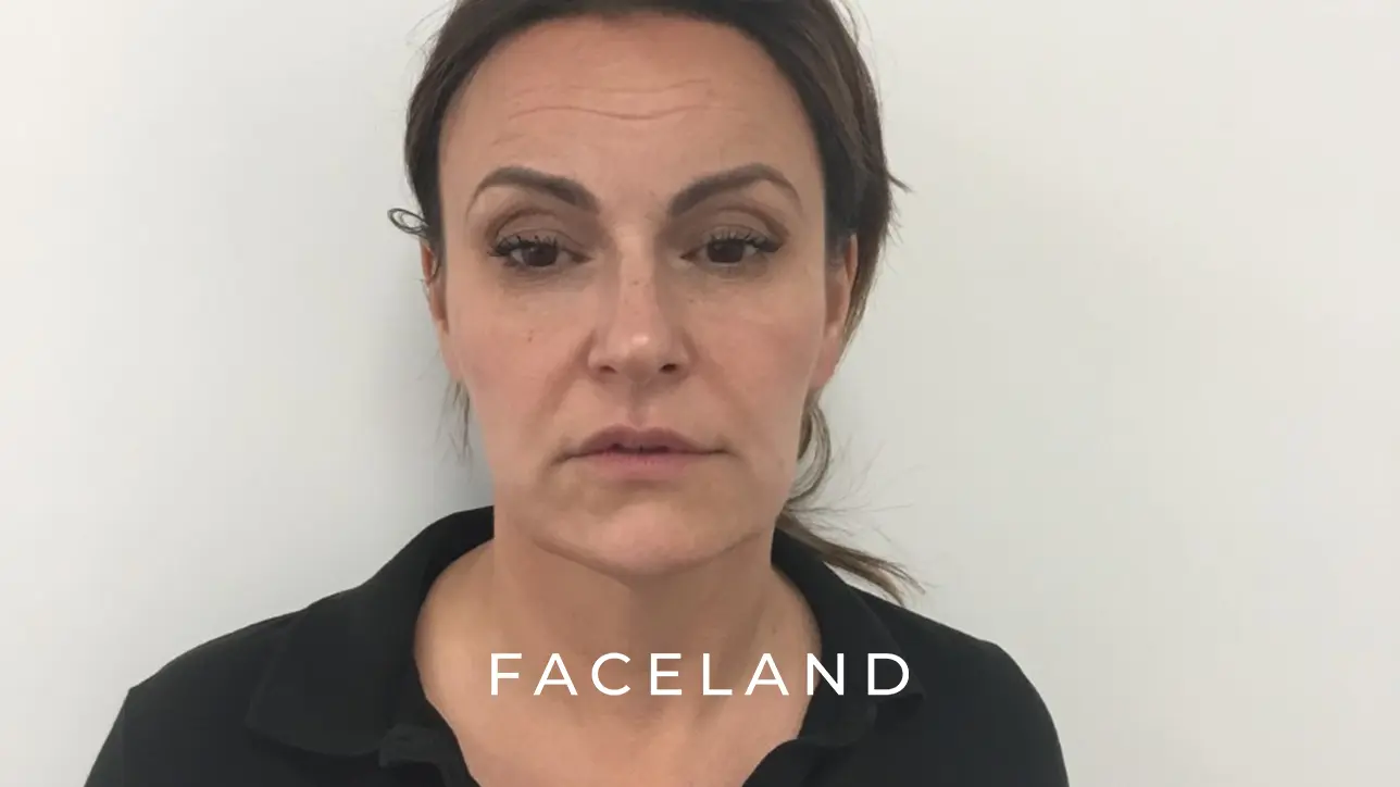 Face slimming