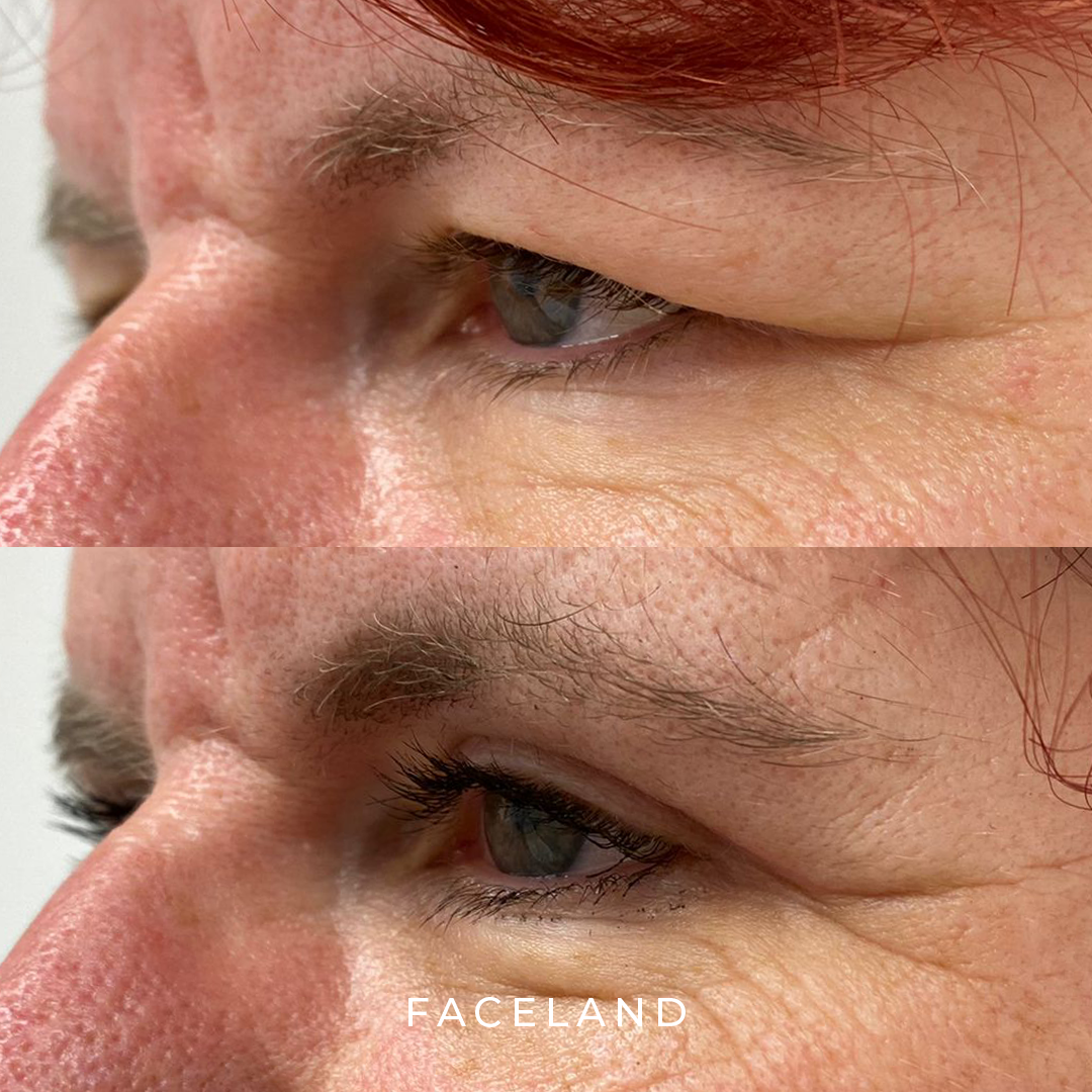 Wat is een bovenooglidcorrectie?