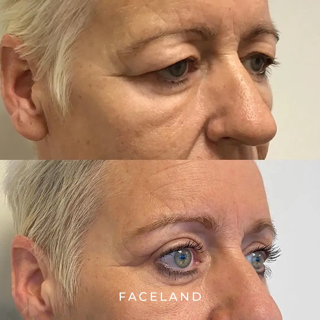 Result eyelid surgery