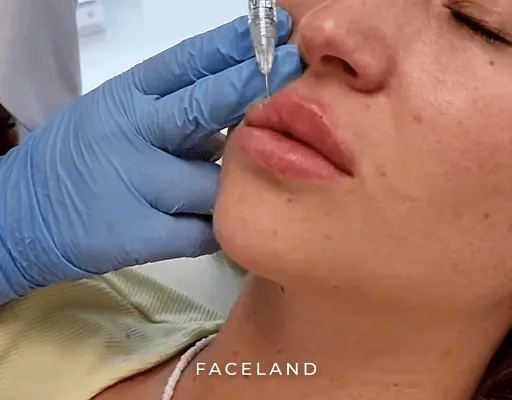 Filler behandeling