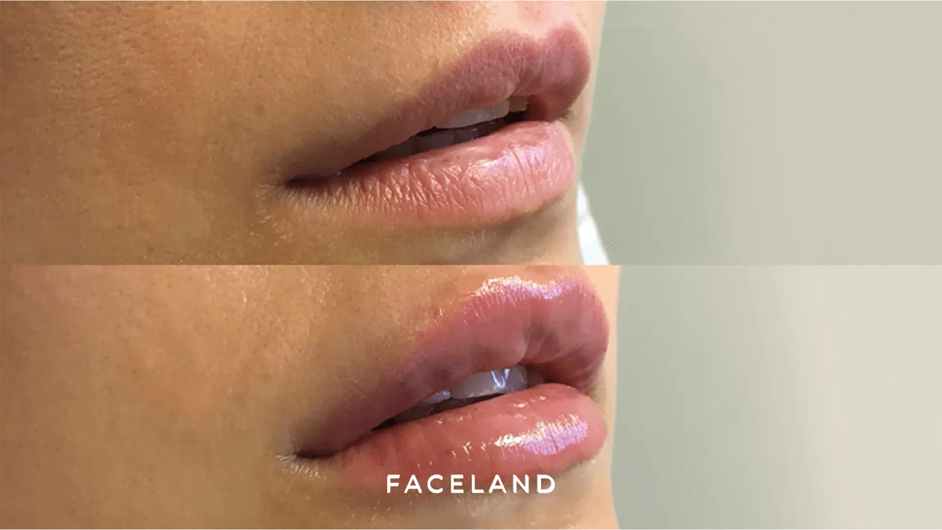 Lip fillers voor en na