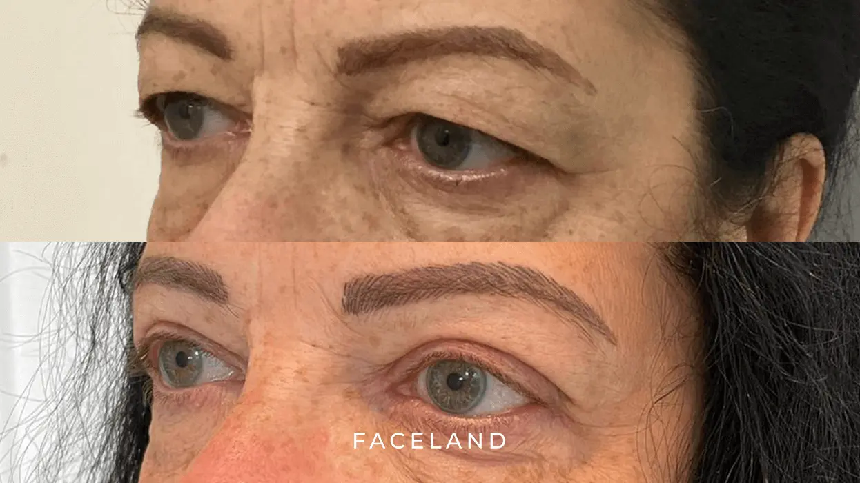 Upper eyelid surgery