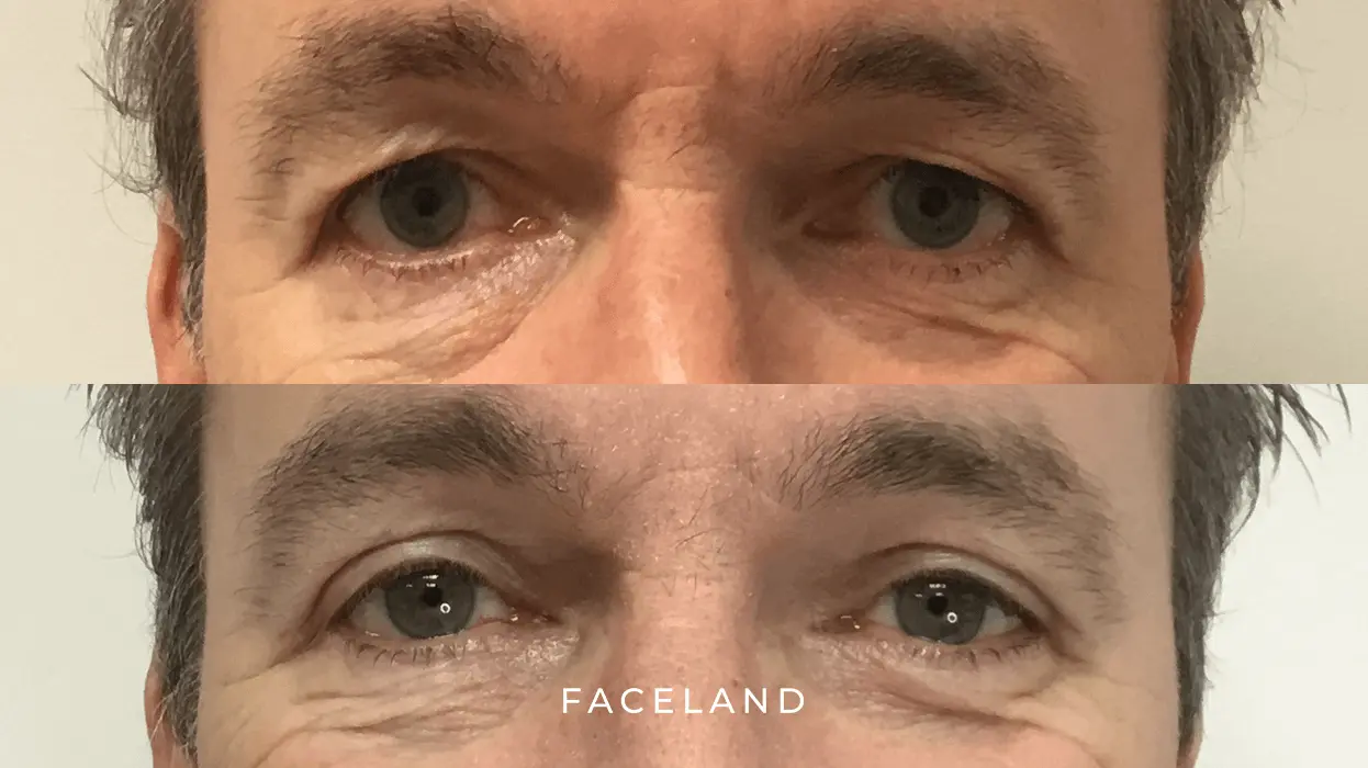 Hangende oogleden before and after
