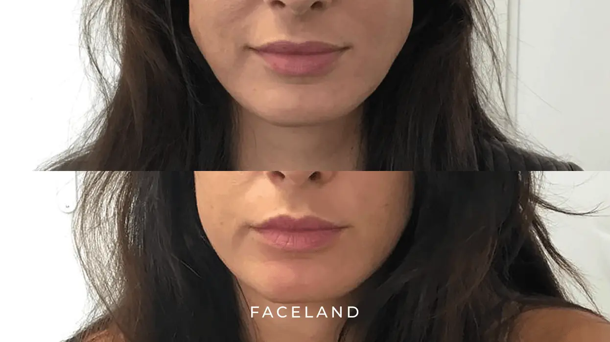 Face slimming before and after